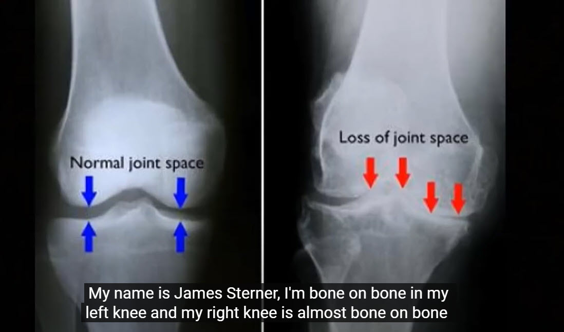 James Was Skeptical Yet Found Relief Of His Knee Pain, Harcourt Chiropractic Office, York PA